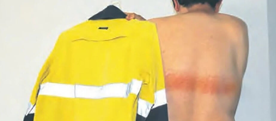 Светоотражающая лента способна обжечь кожу. Фото.