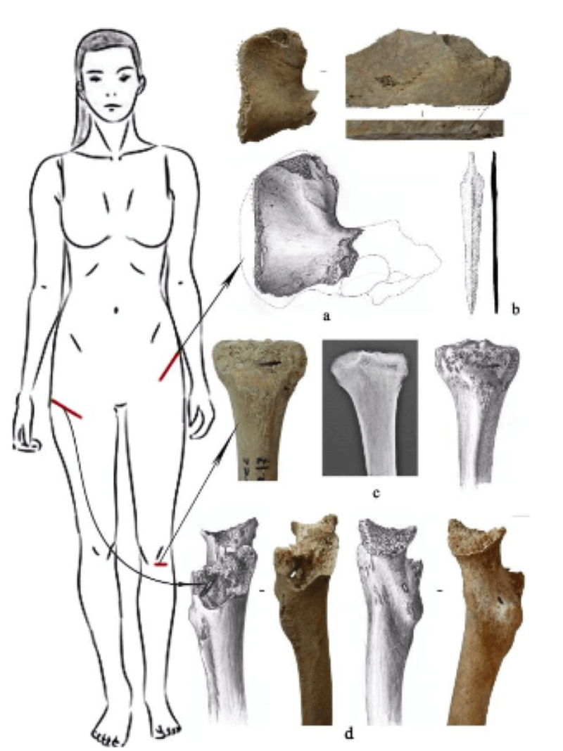 Участвовали ли женщины в войнах? Красными линиями отмечены места, в которые ранили девушку. Фото.