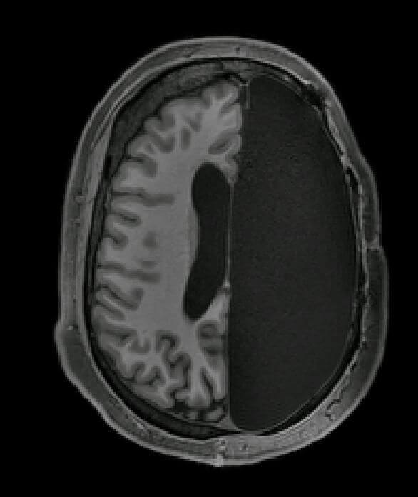 Что такое нейропластичность? МРТ сканирование испытуемых с одним полушарием. Фото.