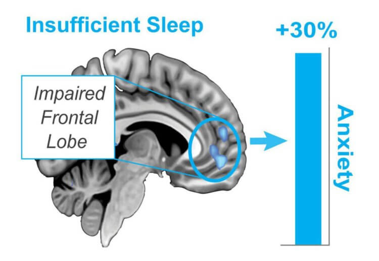 Мозговая активность во время сна. Исследование показывает, что бессонная ночь повышает уровень тревожности до 30%, отключая при этом префронтальную медиальную кору головного мозга. Фото.