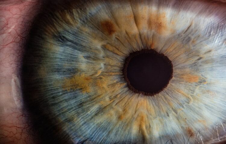 Из-за чего в глазах заводятся черви? В глазах могут завестись и другие черви. Например, однажды врачам удалось извлечь из глаза мужчины 15-сантиметровую Нитчатку Банкрофта. Фото.