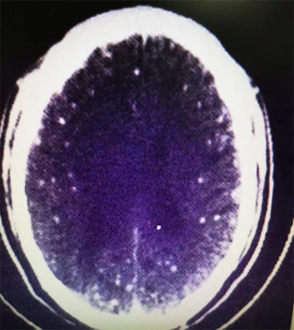 Чем опасно недожаренное мясо? Белым цветом показаны следы ленточных червей в мозге пациента. Фото.