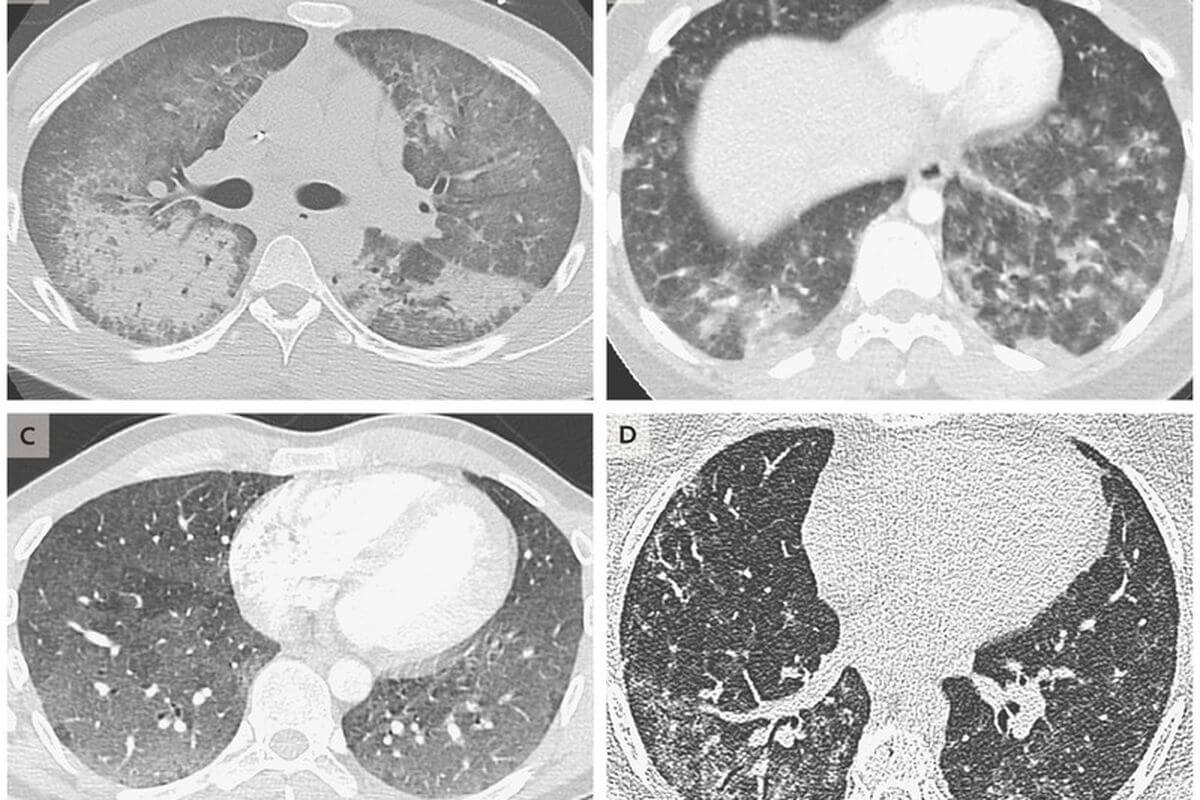 Вот так выглядят поврежденные ткани легких пациентов. Фото.
