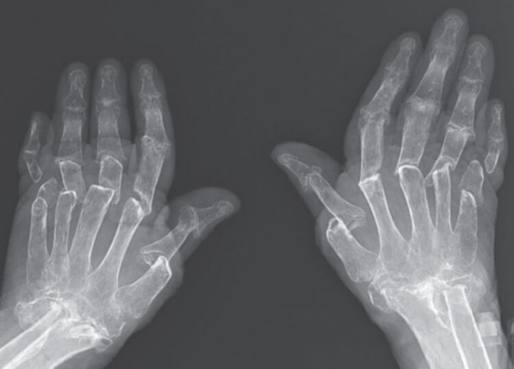 Опасные осложнения ревматоидного артрита. Рентгеновский снимок рук пациентки. Фото.