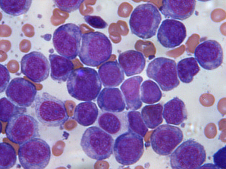 Почему лейкемия считается детским заболеванием? Клетки крови при лейкемии. Фото.
