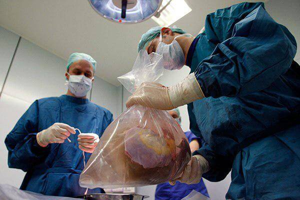 Подготовка органов для трансплантации. Для поддержания жизнеспособности органа используют специальный питательный раствор. Фото.