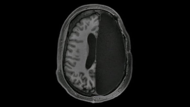 Удаление мозга при эпилепсии. Нейронные связи между системами головного мозга были сильнее у людей с удаленной половиной мозга. Фото.