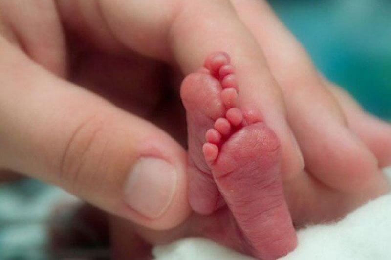 Ребенок, рожденный на 23 неделе, с легкостью может уместиться на ладони и весит всего около 500 грамм. Фото.