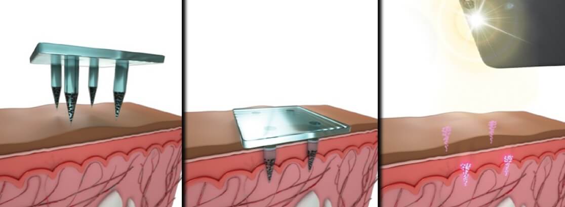 Квантовые технологии помогают в медицине. Схема применения квантового “пластыря”. Фото.