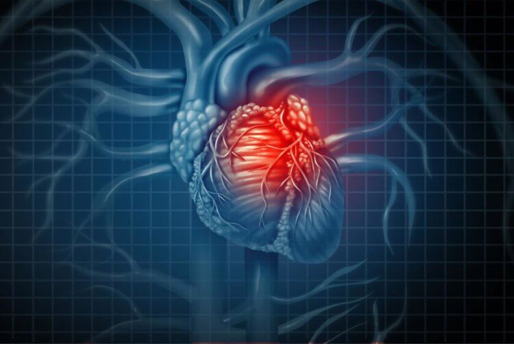 У кого может случиться повторный сердечный приступ? Сердечные приступы являются основными причинами смертности в мире. Фото.