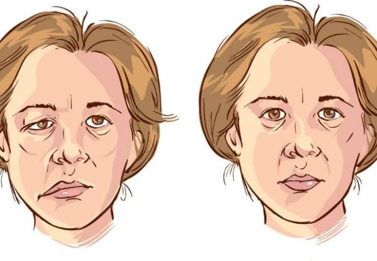 Паралич лица в самолете. Схематичное изображение того, что происходит с лицом человека при параличе лицевого нерва. Фото.