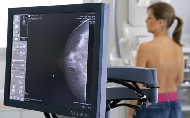 Искусственный интеллект распознает рак груди лучше, чем профессиональные доктора. Фото.