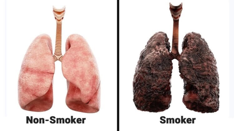 Как возникает рак легких? Классическая картинка — легкие здорового человека и легкие курильщика. Фото.