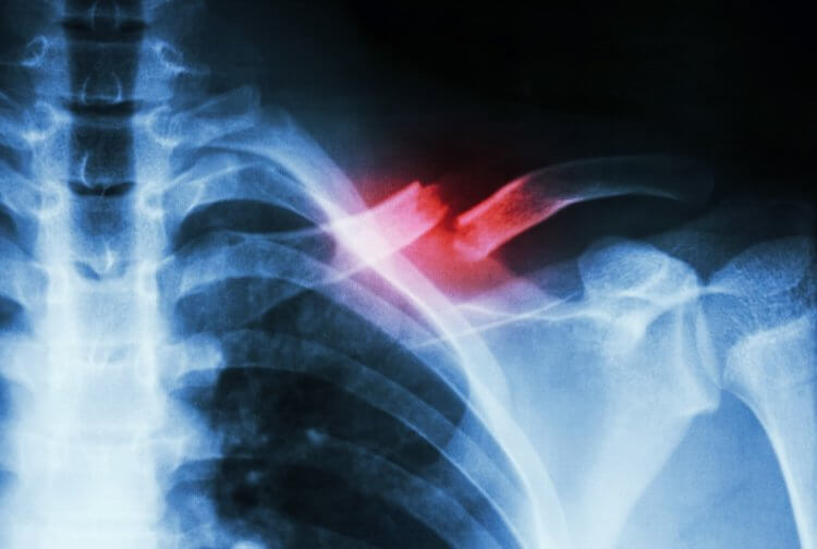 Как вылечить перелом? Новое экспериментальное лечение может помочь при лечении костных повреждений. Фото.