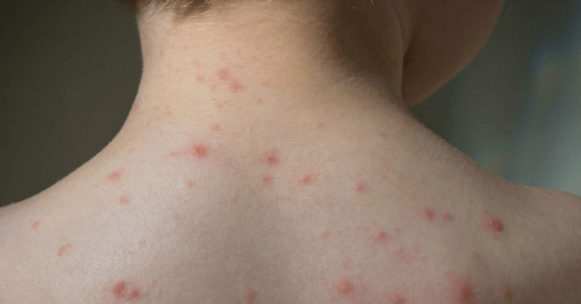 Такая сыпь тоже может быть симптомом заражения COVID-19. Фото.