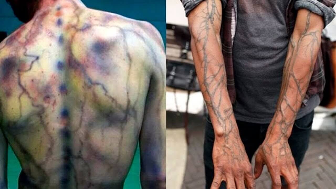 Опасно ли попадание молнии для человека. Примерно так выглядит человек, в которого ударила молния. Через его тело проходит очень сильный разряд. Фото.