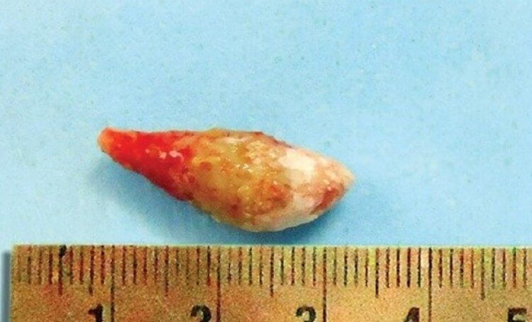 Что такое слюнные камни? Слюнной камень, найденный в челюсти 37-летнего мужчины. Фото.