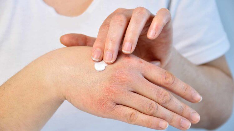 Как развиваются аутоиммунные состояния? Многие люди годами страдают от псориаза на руках. Фото.