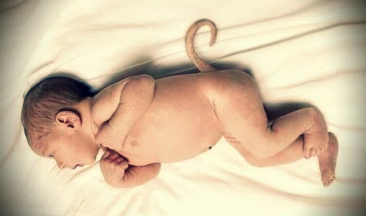 Рудиментный хвост. Некоторые младенцы до сих пор рождаются с хвостами, но их быстро оперируют. Фото.