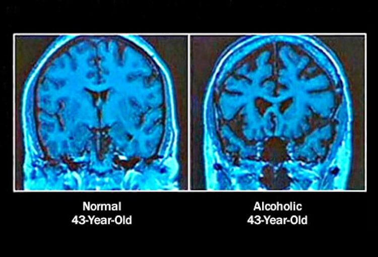 Мозг обычного человека и алкоголика. Во втором случае большинство связей в мозгу разрушены. Фото.