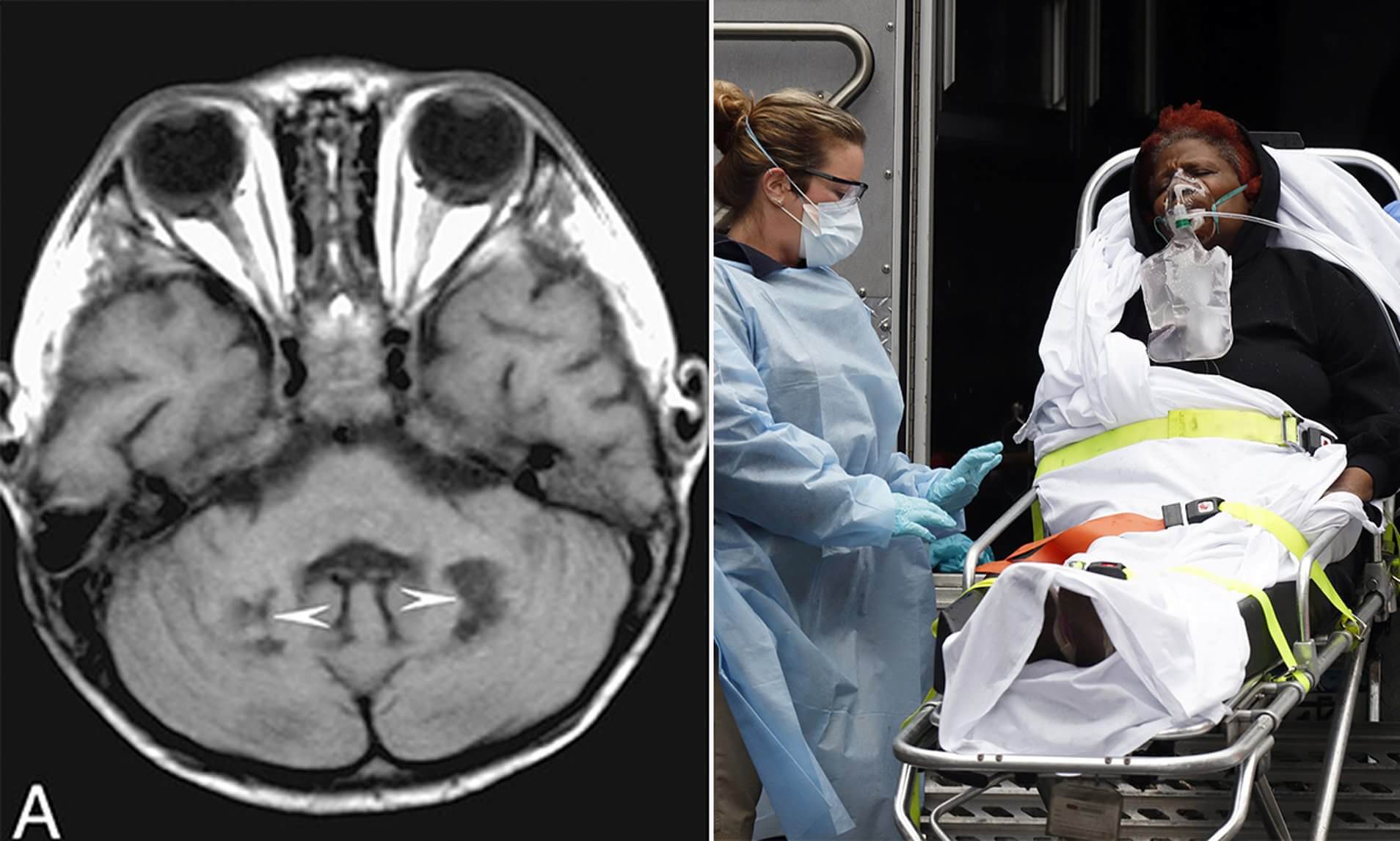 В особенно тяжелых случаях развиваются редкие неврологические заболевания. Фото.