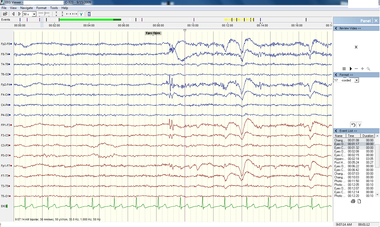 Примерно так выглядят показания снятые с ECoG, которые затем преобразуются в цифровой код. Фото.