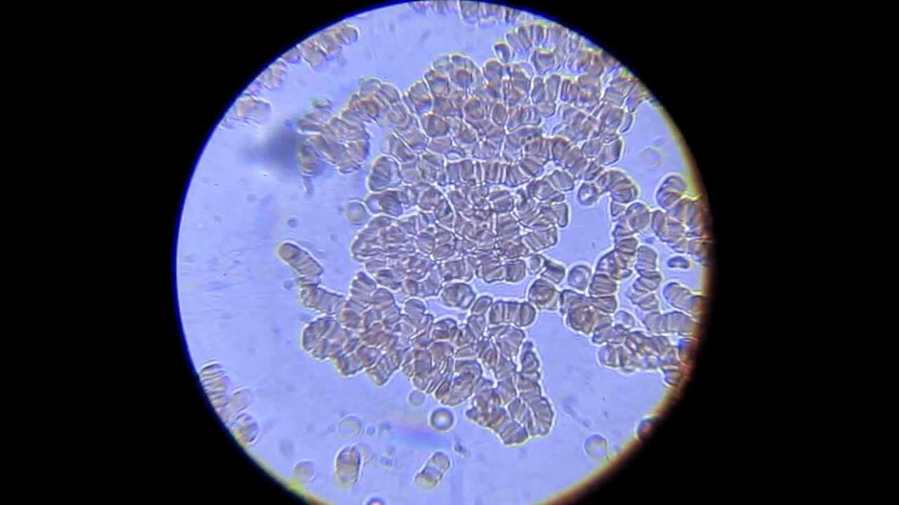 Как действует алкоголь. Эритроциты человека, который употребил большое количество алкоголя. Они почти все слиплись. Как действует алкоголь. Эритроциты человека, который употребил большое количество алкоголя. Они почти все слиплись. Фото.