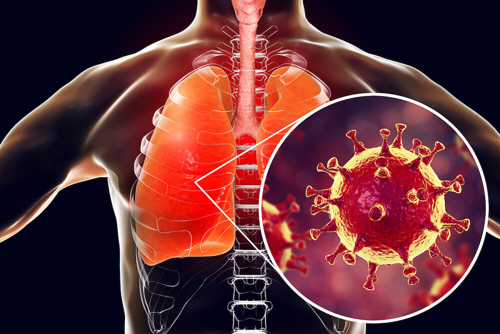 Во время COVID-пневмонии человек может не ощущать симптомов заболевания и это очень опасно. Фото.