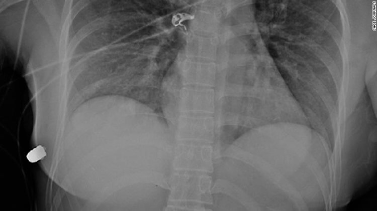 Какие силиконовые имплантаты бывают. Рентгеновский снимок выжившей женщины от пулевого ранения. Фото.