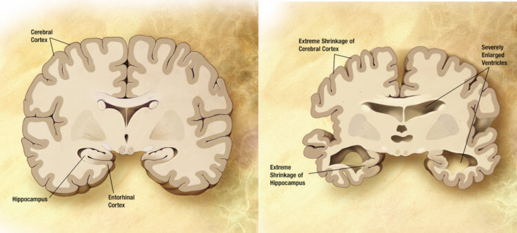 Что вызывает болезнь Альцгеймера. Обычный мозг пожилого человека (слева) и мозг, пораженный болезнью Альцгеймера (справа). Фото.