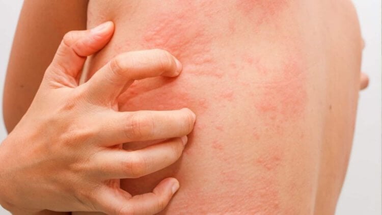 Может ли сыпь на коже быть симптомом коронавируса? Сыпь – новый симптом коронавируса. Фото.