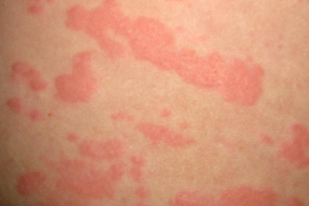 Если вы когда-то сталкивались с крапивницей, то знаете насколько это неприятная штука. Фото.