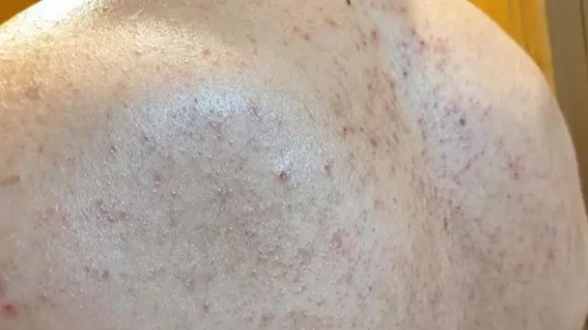 Сыпь – не самый приятный симптом, но эта хотя бы не чешется. Фото.