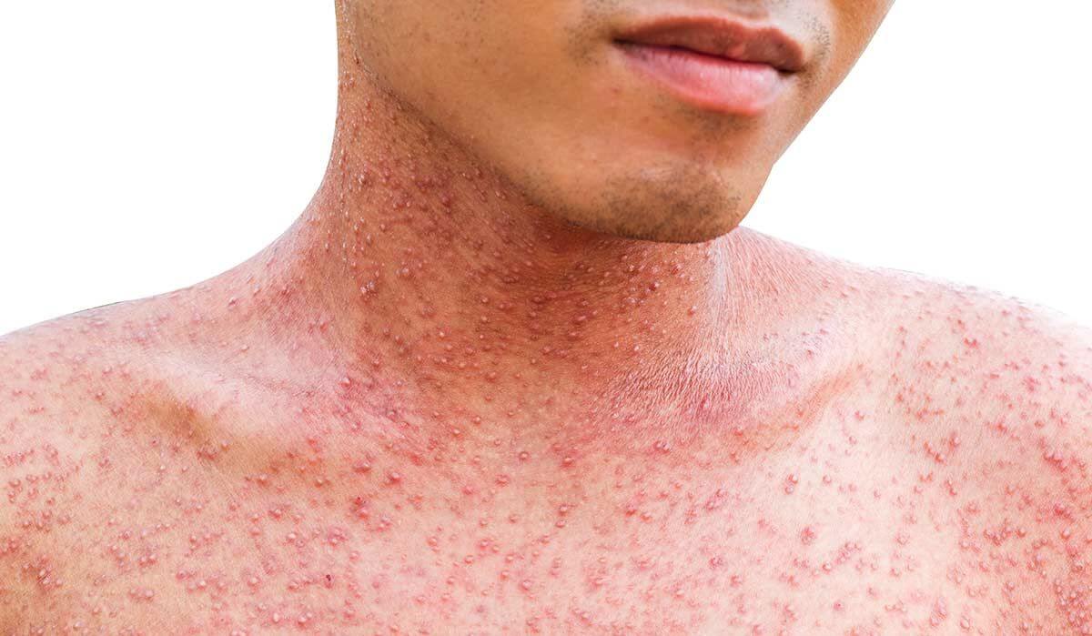 Корь – еще одно вирусное заболевание с сыпью, которая выглядит так. Фото.