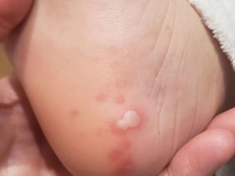 Шишковидные высыпания на ногах и руках. Многие инфицированные коронавирусом сообщили о подобных высыпаниях на коже. Фото.