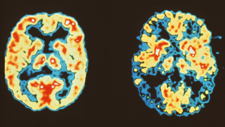 Повторяющиеся негативные мысли связали с болезнью Альцгеймера. Скан мозга здорового человека (слева) и скан мозга человека с болезнью Альцгеймера (справа). Фото.