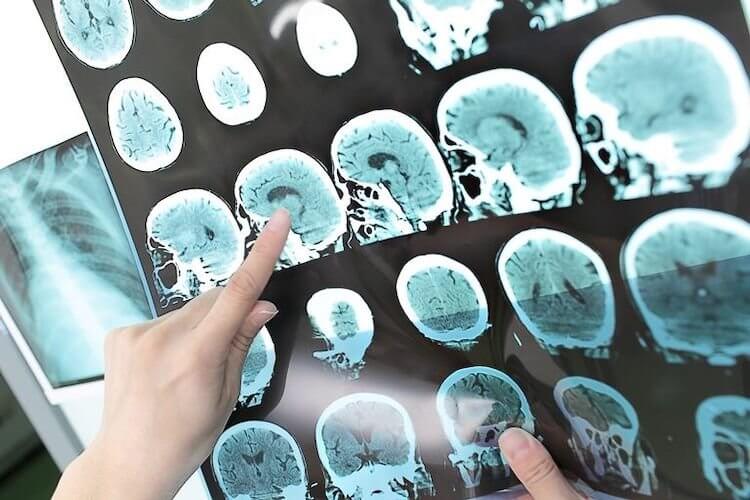 КТ головы и головного мозга. Результат КТ дает подробное изображение срезов головного мозга. Фото.