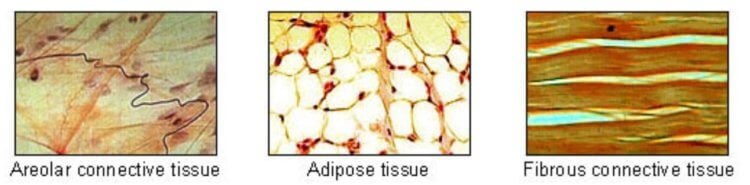 Фиброз миокарда. Фиброзная ткань плохо растягивается, на этом изображении она показана справа. Фото.