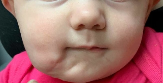 В США родился ребенок со вторым ртом: хирурги провели операцию по его удалению. Фото.