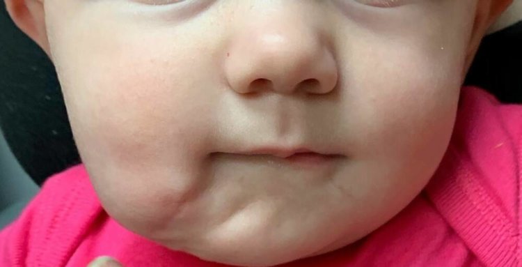 В США родился ребенок со вторым ртом: хирурги провели операцию по его удалению. Лицо девочки после хирургической операции. Фото.