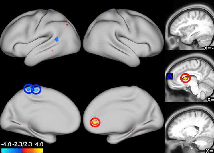 Как антидепрессанты помогают справиться со стрессом? Синим цветом показано ослабление связей в головном мозге, красным — усиление. Фото.