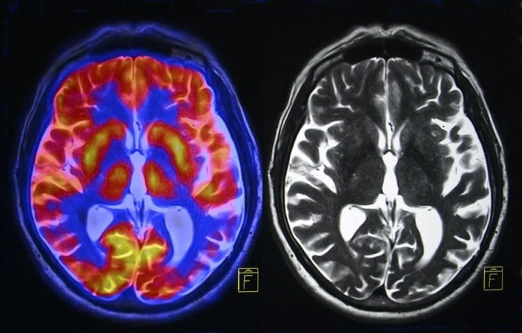 Что происходит с мозгом при смерти близкого человека? Психическая травма буквально разрушает мозг. Фото.