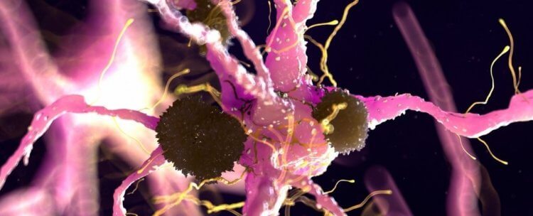 Как отличить болезнь Паркинсона? Тельца Леви поражают нейроны. Компьютерная модель. Фото.
