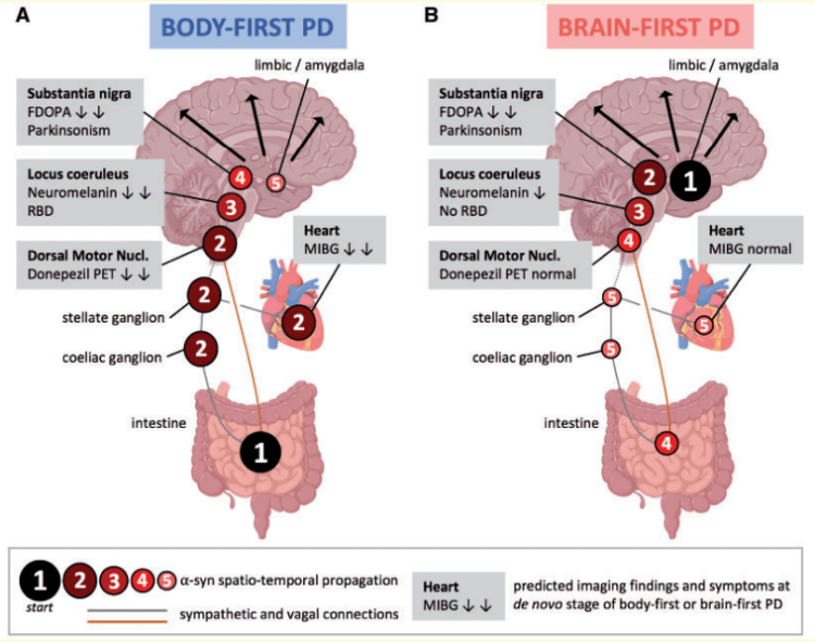 Почему возникает болезнь Паркинсона? В первом случае (слева) болезнь формируется в кишечнике (1), далее идет в сердце (2) и по блуждающему нерву попадает в мозг. Во втором случае (справа) заболевание формируется в мозге (1) и только потом поражает кишечник и сердце. Фото.