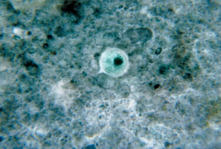 Что такое амебная дизентерия? Дизентерийная амеба под микроскопом. Фото.