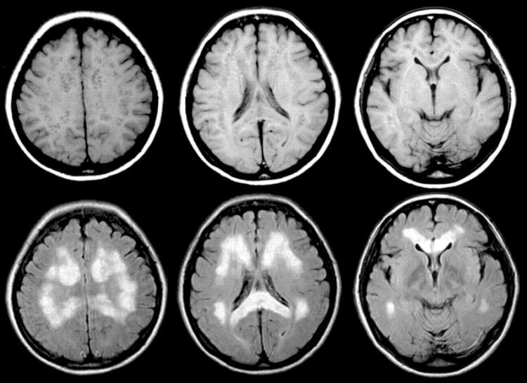 Из-за чего развивается болезнь Паркинсона? Поражение мозга в связи с болезнью Паркинсона. Фото.
