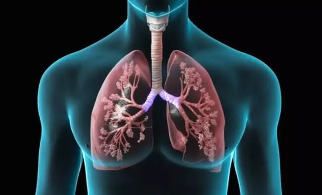 Оценить тяжесть пневмонии можно в Интернете, без томографии. Что для этого нужно? Фото.