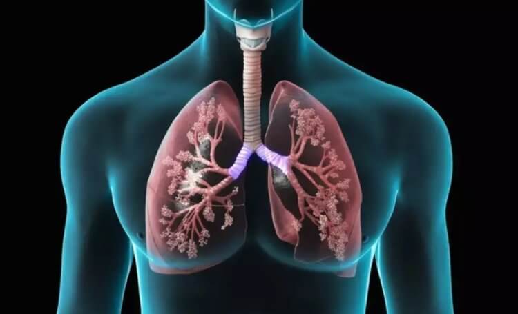 Оценить тяжесть пневмонии можно в Интернете, без томографии. Что для этого нужно?