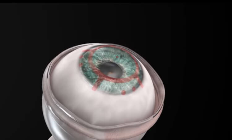 Что такое искусственная роговица глаза и зачем она нужна? Имплантат CorNeat KPro заменяет собой естественную роговицу глаза, которая нужна для преломления света. Фото.