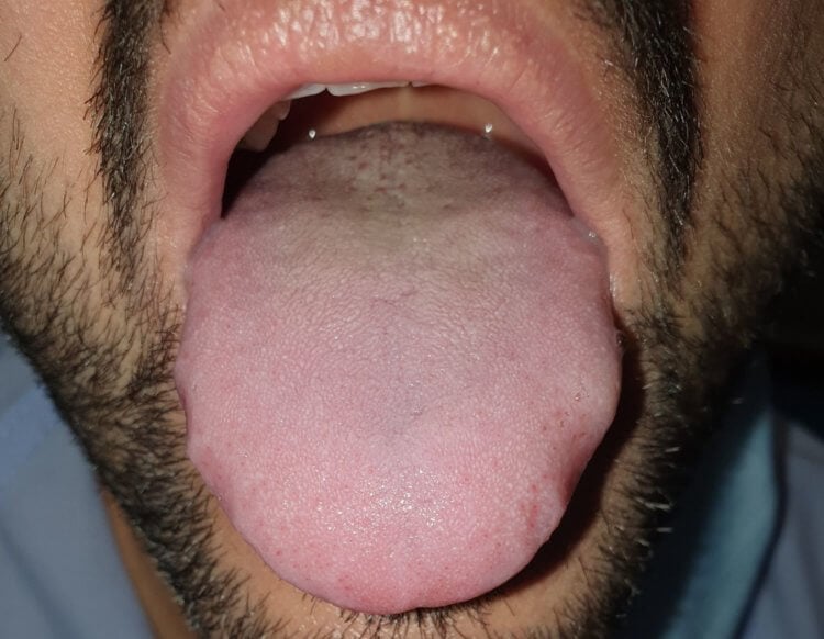 Можно ли диагностировать COVID-19 по языку? Увеличенный язык с отметинами зубов по бокам пациента с ковидом. Фото.